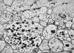 M,3y. | neuroblastoma - adrenal